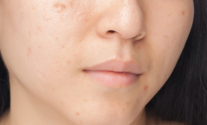 Aprende a cuidar tu piel para prevenir la aparición de marcas de acné